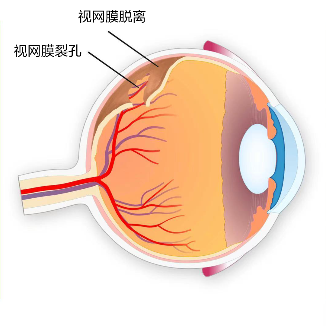 視網(wǎng)膜脫離